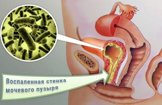 Геморрагический цистит