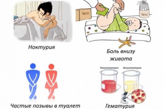 Цистит у девочек