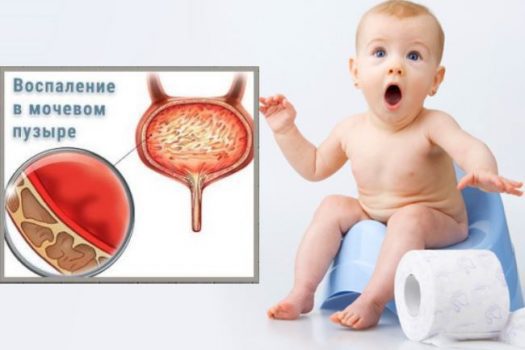 Цистит у ребенка