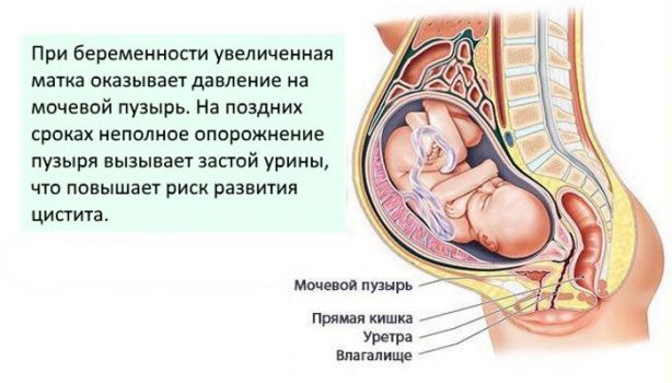 Цистит как признак беременности