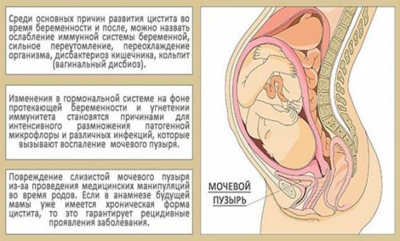 Цистит при ГВ