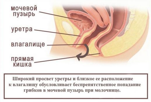 Молочница и цистит