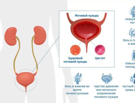 Cимптомы цистита у женщин