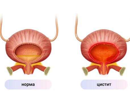 Симптомы цистита у мужчин